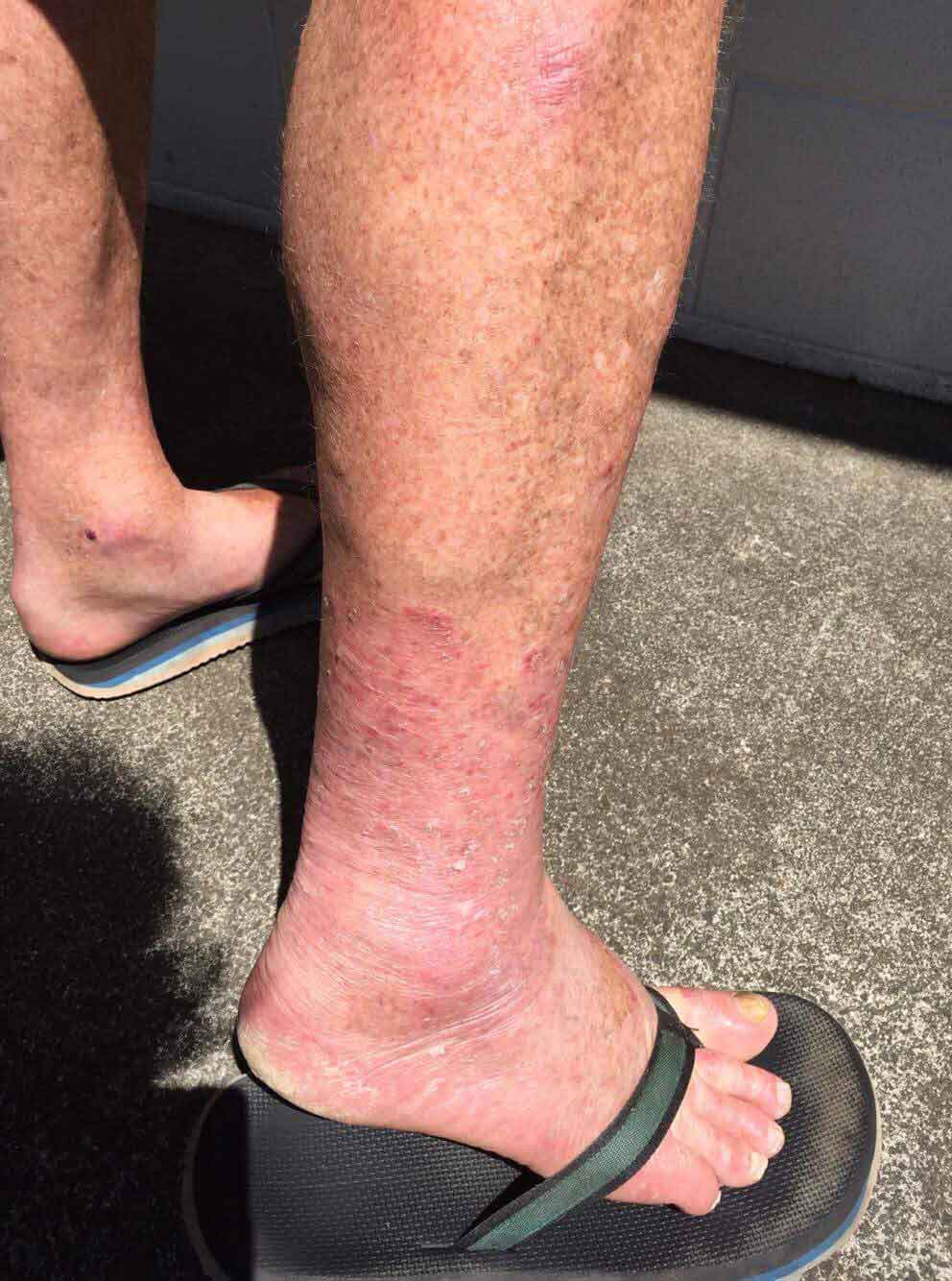 chronic multi drug resistant fungal skin infection before treatment