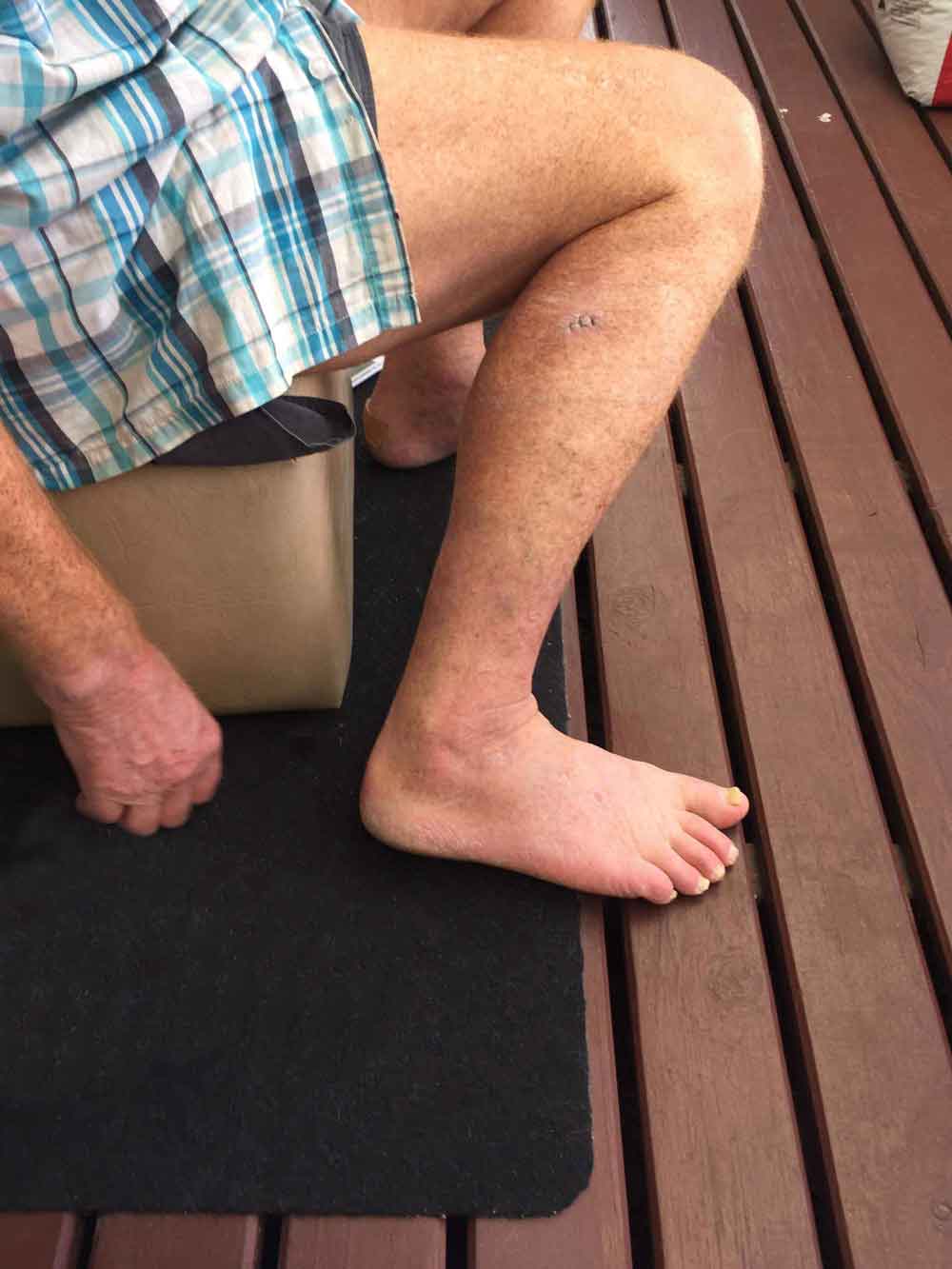 chronic multi drug resistant fungal yeast skin infection after treatment and biopsy